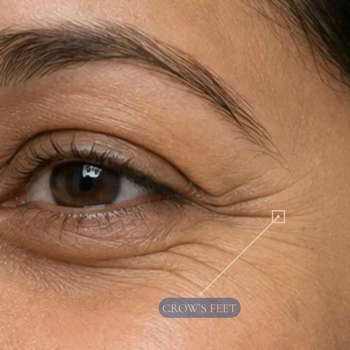 Anti-Wrinkle Injections