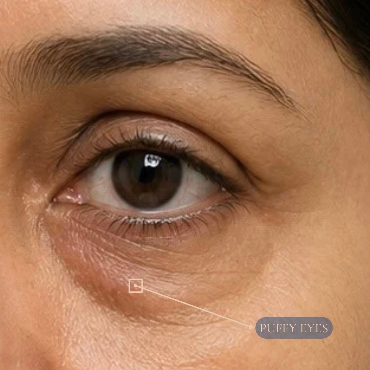 Upper & Lower Blepharoplasty