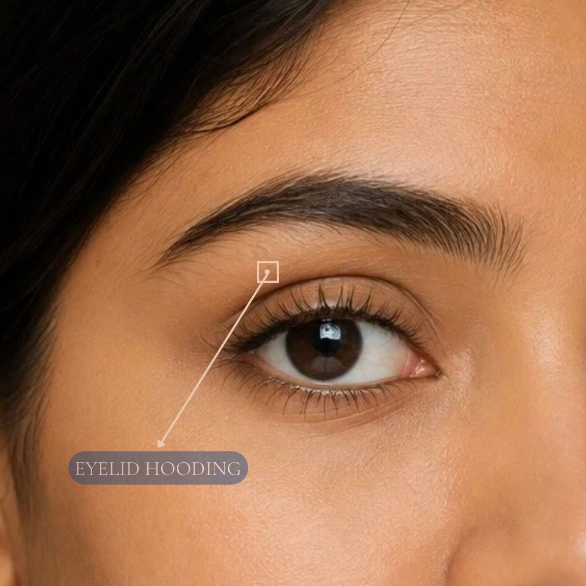 Brow Lift