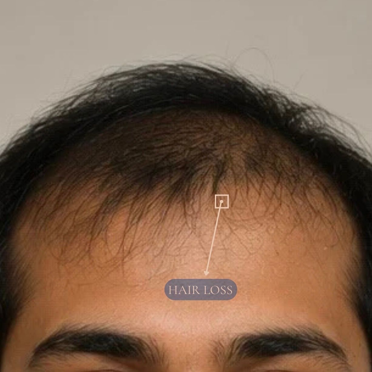 Hair Transplant