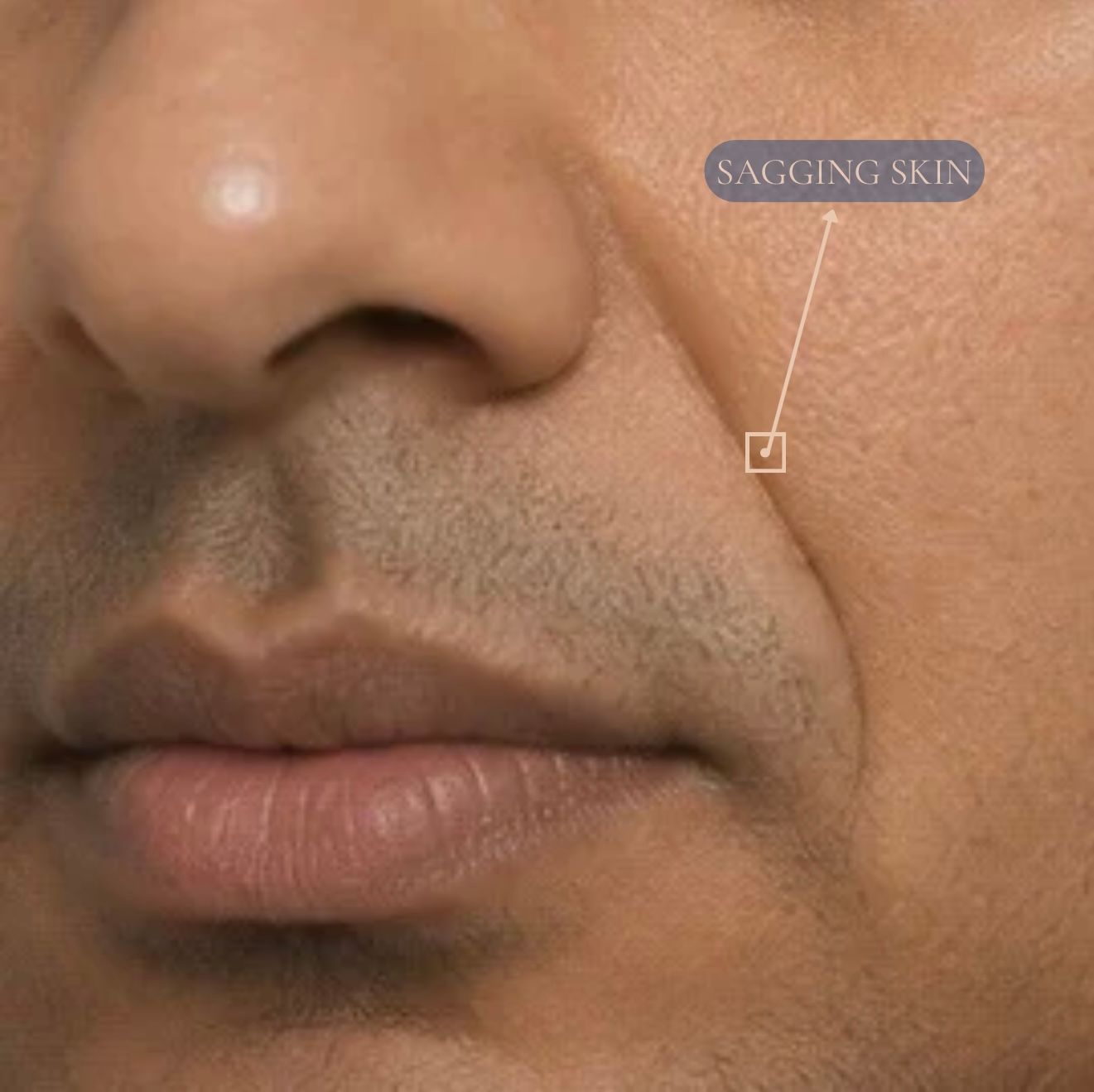 Thread Lift