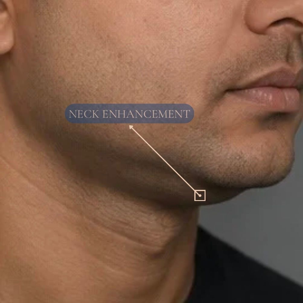 Platysmaplasty